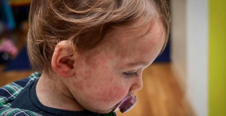 Impacto da dermatite atópica na qualidade de vida dos doentes pediátricos