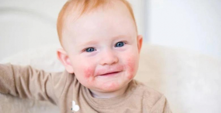 Abundância de ruminococcus bromii associada a níveis de butirato fecal e dermatite atópica na infância