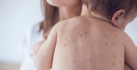 Sarampo foi a causa de morte de mais de 140 mil pessoas no mundo em 2018