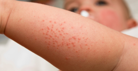 Fenótipos de dermatite atópica em crianças